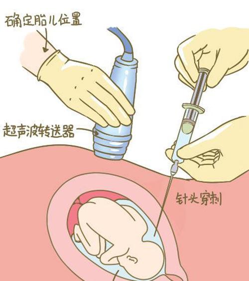 自贡羊水孕期亲子鉴定